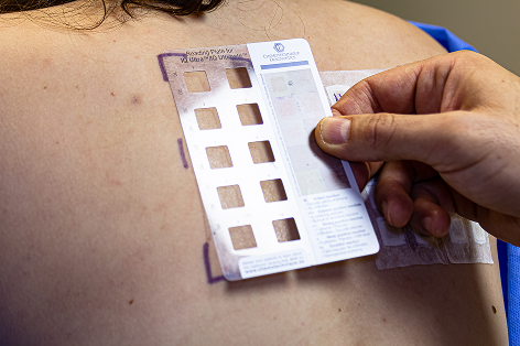 skin-allergy-reaction-person-s-back (2)